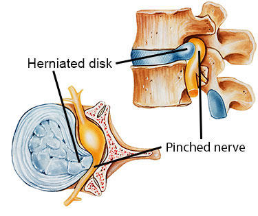 Herniated Disk Illustration
