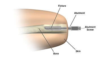 OPRA Prosthetic Implant in Femur