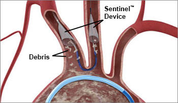 Sentinel Device With TAVR