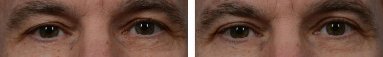 Blepharoplasty Eyelid Surgery Before and After