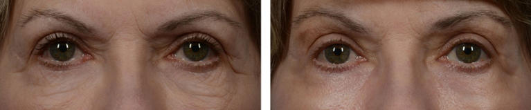 Laser Resurfacing Eye Area Before and After