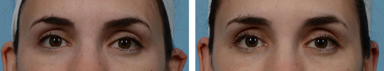 Eye Surgery Otoplasty Before and After