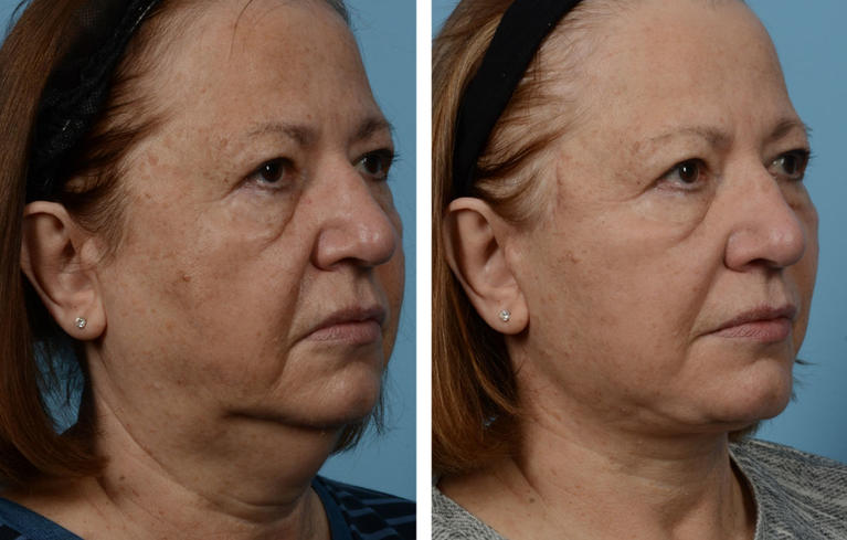 Face Lift Before and After