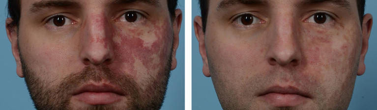VBeam Laser Therapy Port Wine Stain Before and After