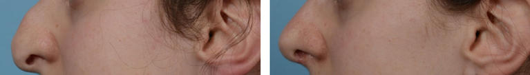 Nose Job Rhinoplasty Before and After