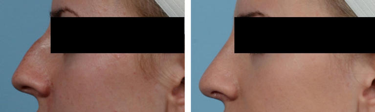 Nose Job Rhinoplasty Before and After