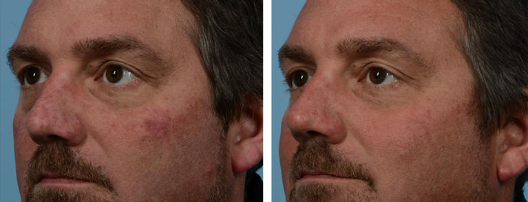 VBeam Laser Therapy Before and After
