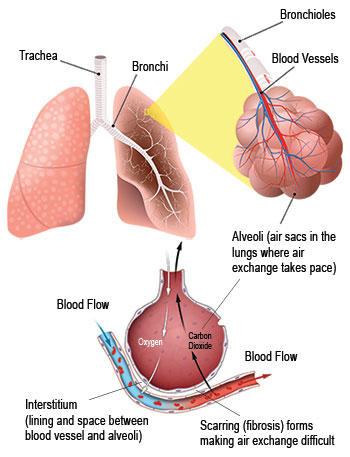 Interstitial Lung Disease (ILD) Lung and Alveoli Diagram
