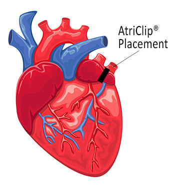AtriClip Placement for LAA