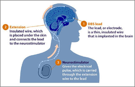 DBS Lead and Neurostimulator Placement