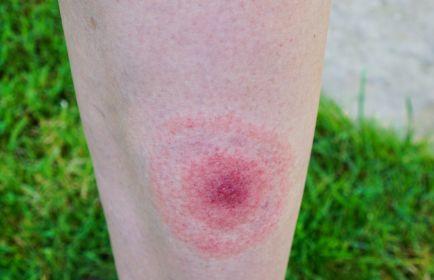 Bullseye Rash Lyme Disease Symptom