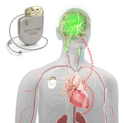 Barostim Heart Failure Therapy Device and Placement