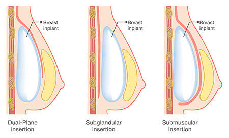 Breast Augmentation Implant Placement