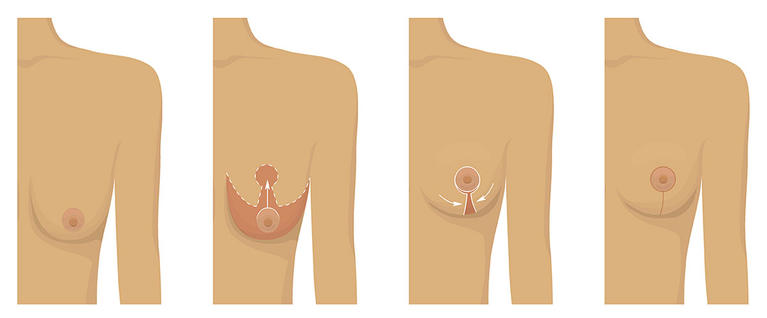 Breast Lift Procedure and Incision Placement