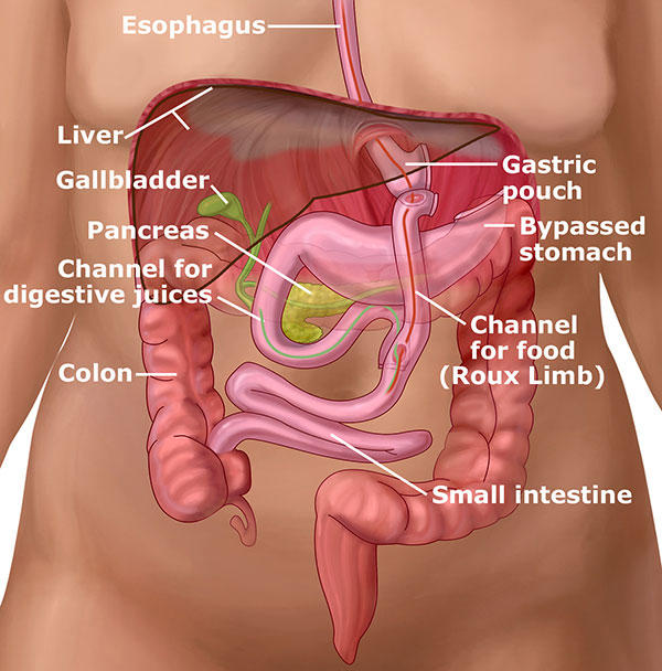 Gastric Bypass Bariatric Surgery Illustration