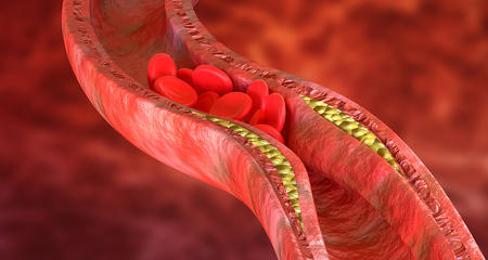 bad cholesterol in artery