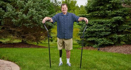 Kirk Billingsley, amputee patient with OPRA implant system