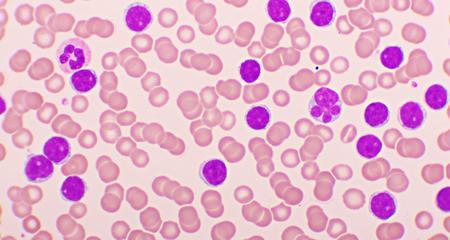 Rare Cancer Acute Myeloblastic Leukemia Cells