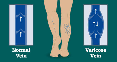 Normal versus varicose veins.