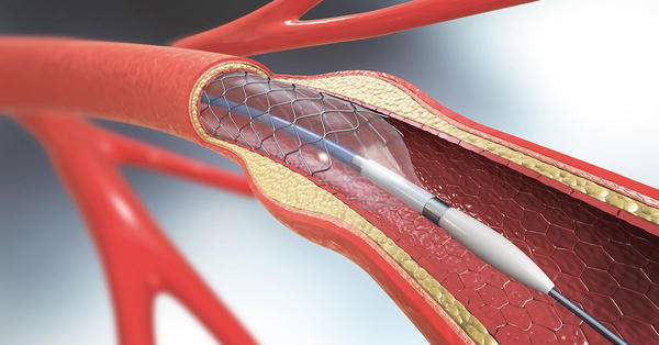 carotid-artery_stent