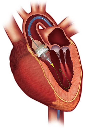 Illustration of valve-in-valve TAVR in the heart