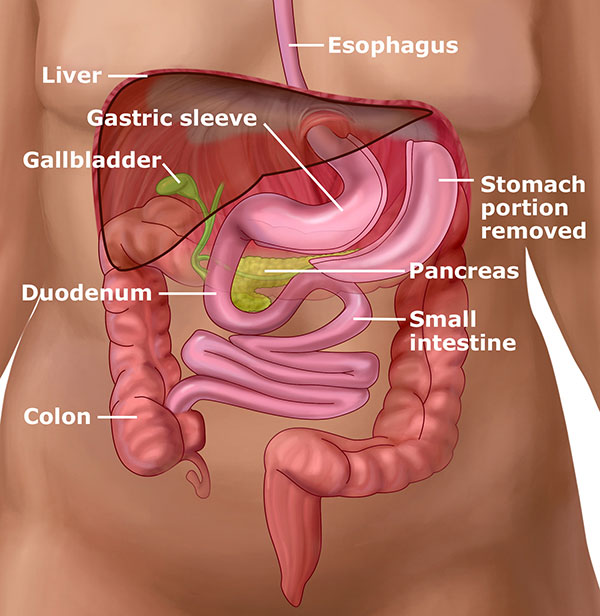 Gastric Sleeve Procedure, Bariatric Surgery Illustration