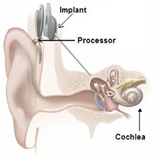 Cochlear Implant image